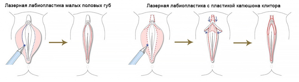 Метод лабиопластики 2.jpg